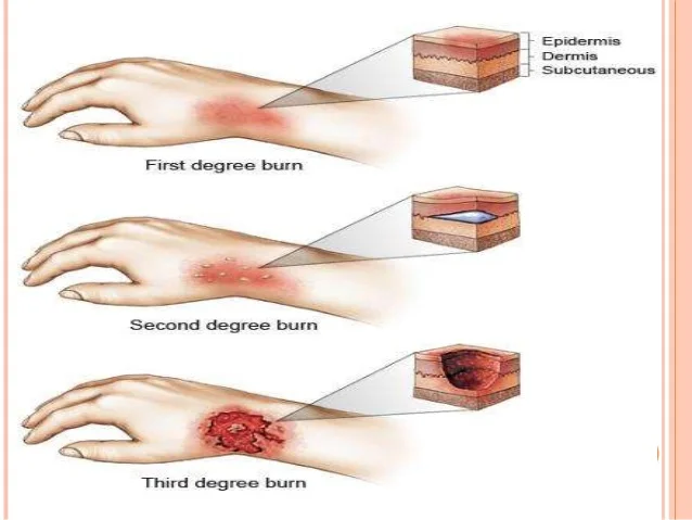 ‘Burns’ – All you needed to know – Types of Burns | Precautions | First Aid | Emergency |DESUN Hospital Burns Unit Kolkata | Siliguri
