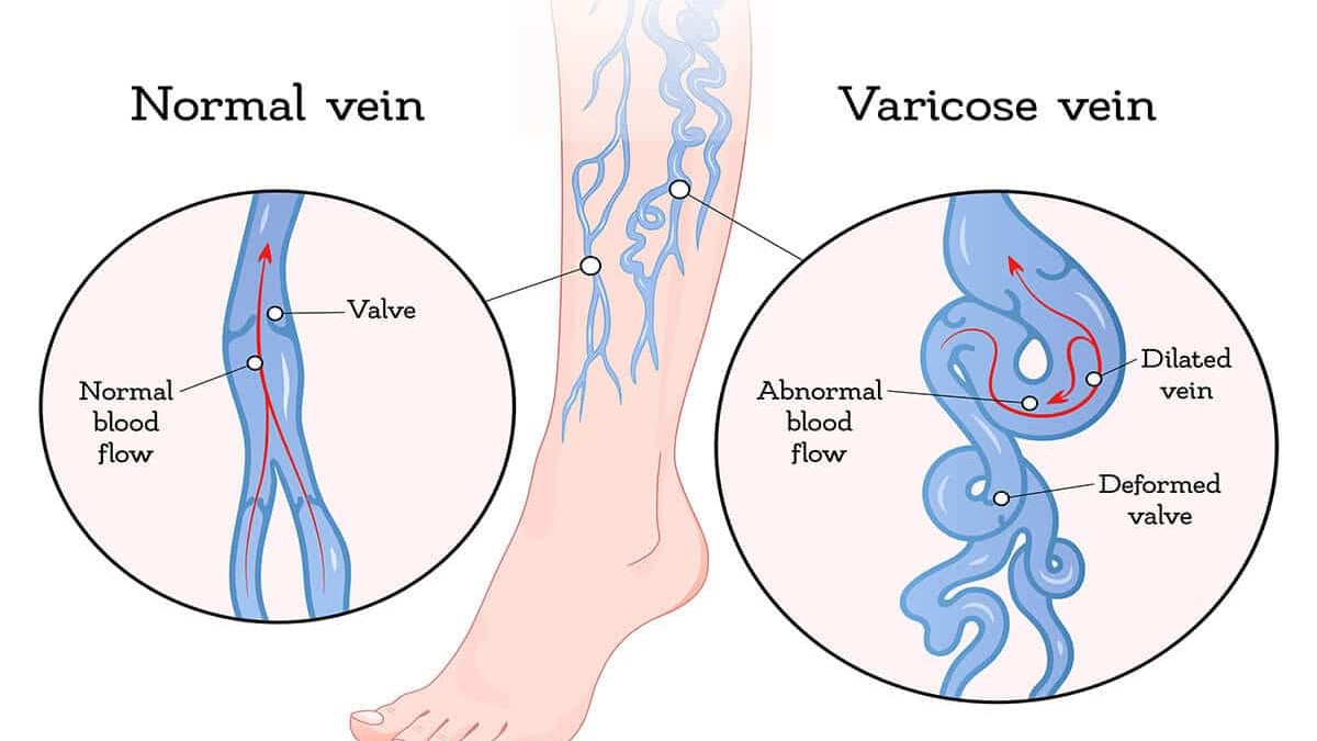 Varicose Veins – Definition |Symptoms | Causes |Precautions | Diagnosis | Treatment