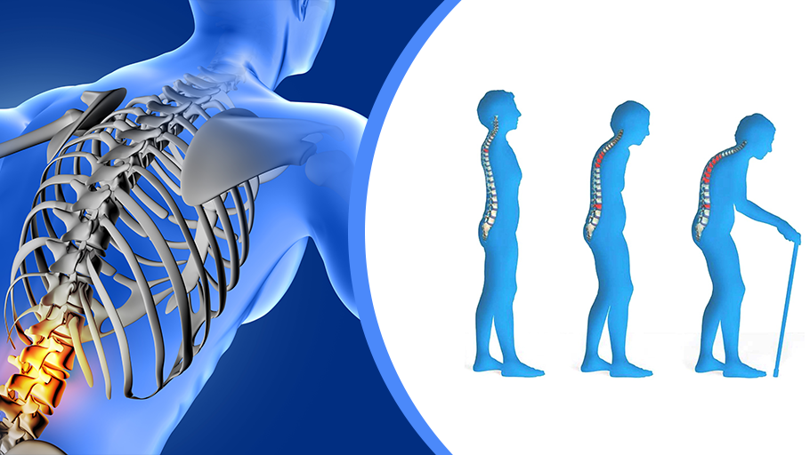 Few Early Signs of Osteoporosis